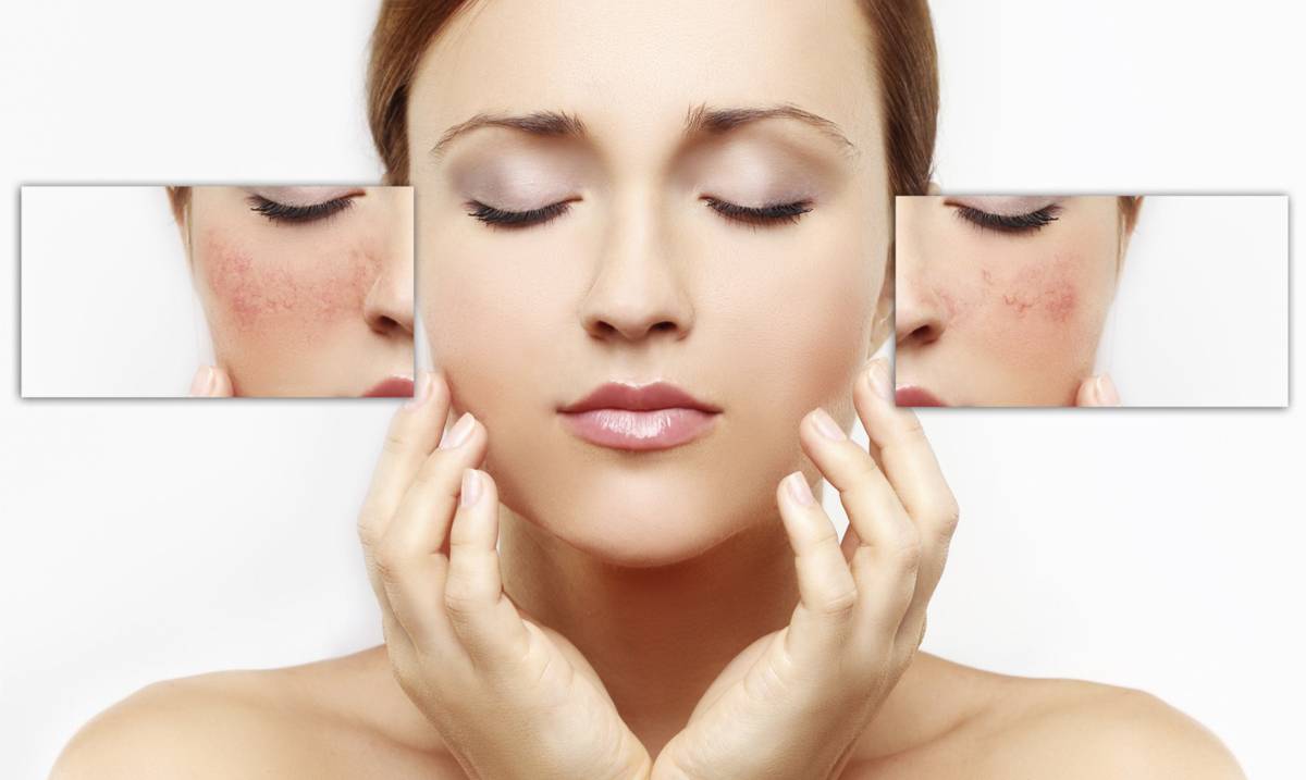 Thuốc trị nám da mặt 1 Thuốc trị nám da mặt