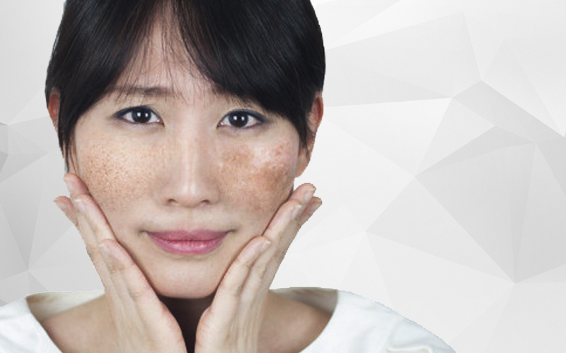 Thuốc trị nám da mặt 5 Viên uống trị nám cấp tốc